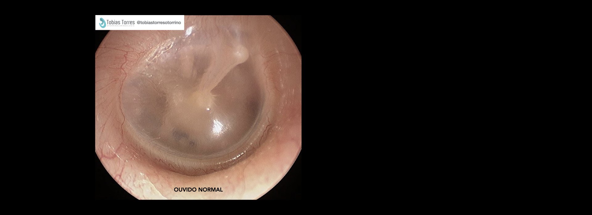 Video-Otoscopia - Exame Endoscópico do Ouvido